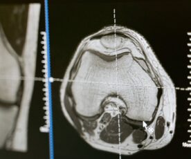 Tudo sobre traumatismo craniano: o que é, sequelas e tratamento