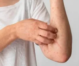 Identificar uma Alergia Alimentar – Guia Rápido