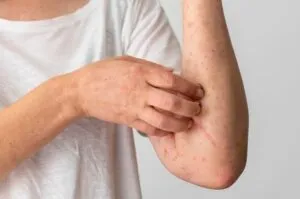 Identificar uma Alergia Alimentar – Guia Rápido Identificar uma Alergia Alimentar – Guia Rápido