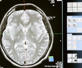 Cérebro: 5 doenças neurológicas que podem afetar o órgão