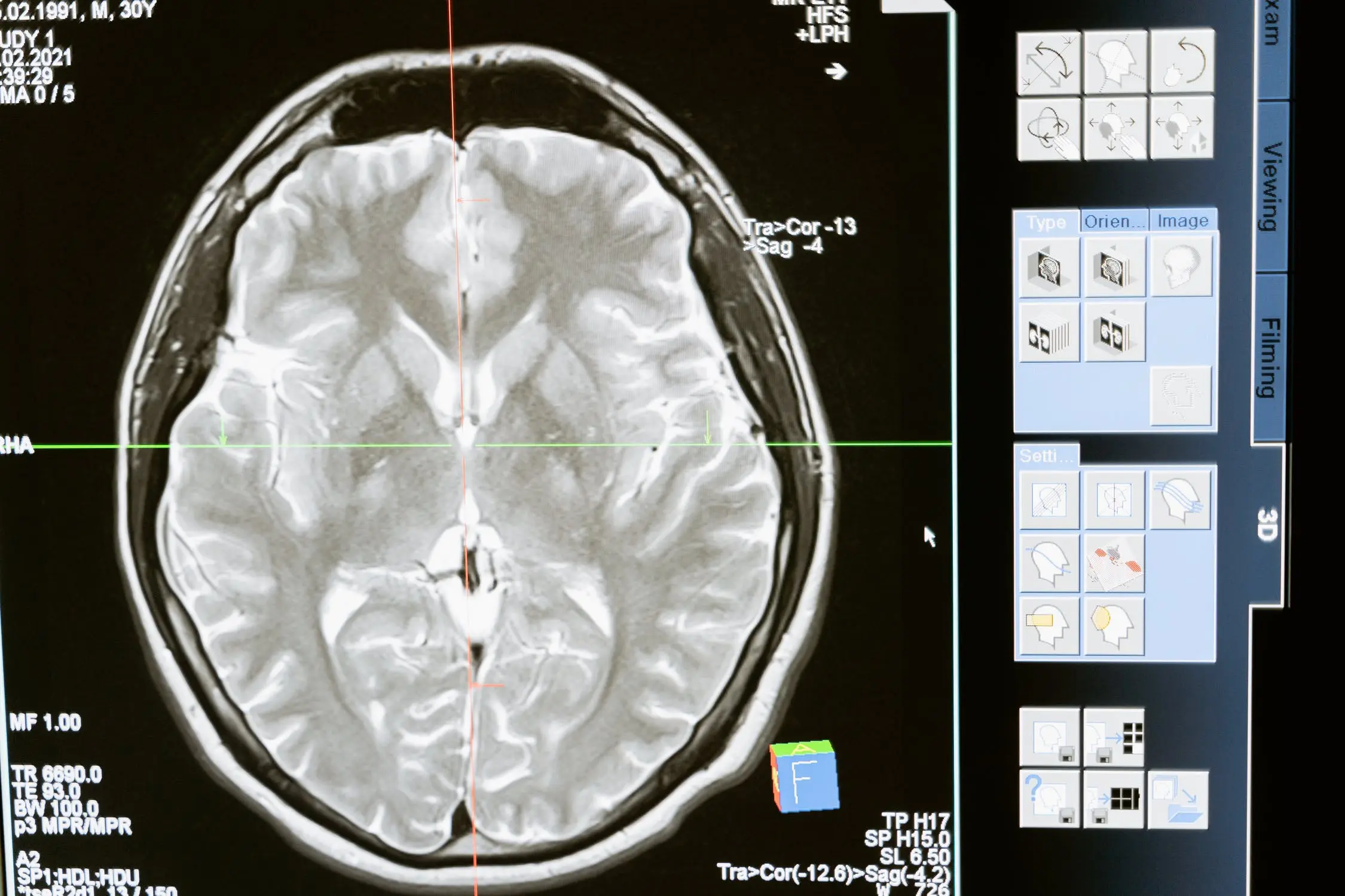 Cérebro: 5 doenças neurológicas que podem afetar o órgão cerebro