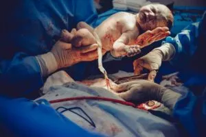 Como Cortar o Cordão Umbilical – Guia Rápido