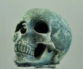 Fratura Craniana – Guia Rápido