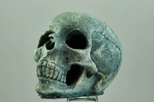 Fratura Craniana – Guia Rápido Fratura Craniana – Guia Rápido